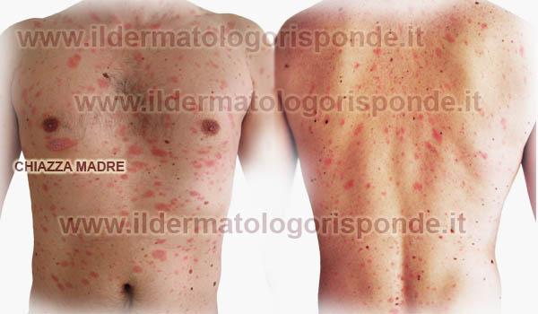 Segni di eczema allergici